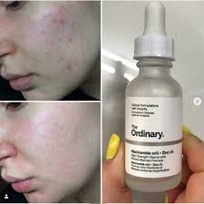 The Ordinary Niacinamide 10% + Zinc 1% β 30ml